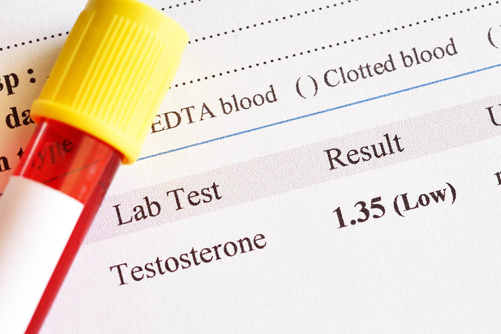 Testosterone deficiency lab test